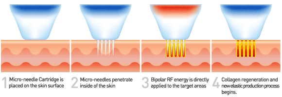 Microneedling RF VS Fractional Laser