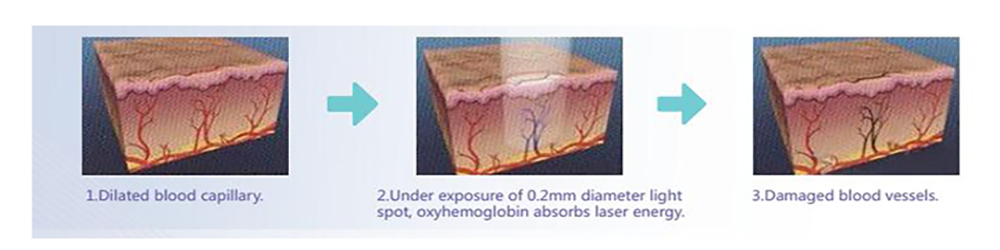 980nm Diode Laser Vascular Veins Removal Machine