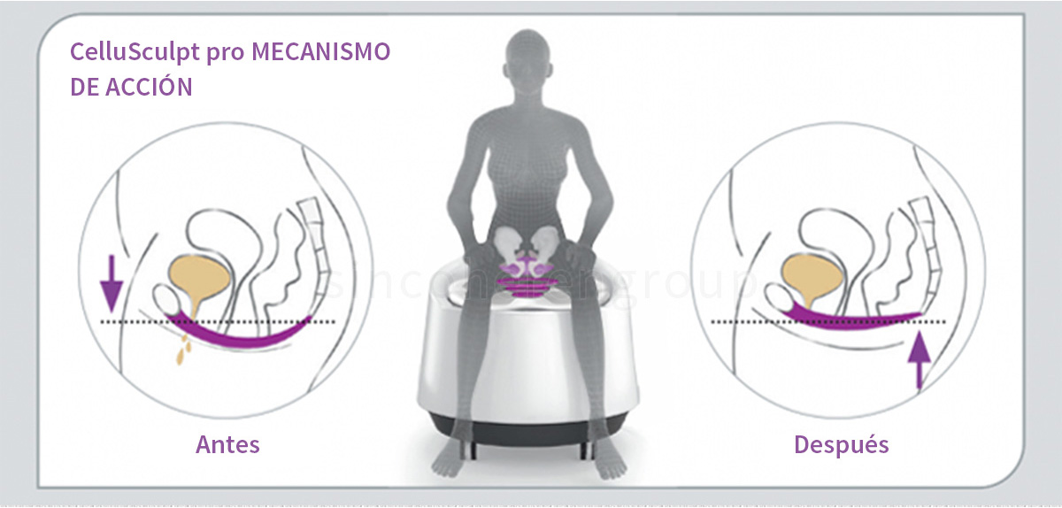 CelluSculpt Pro HI-EMT dispositivo para la construcción de músculo, pérdida de peso y tratamiento de flgor pélvico