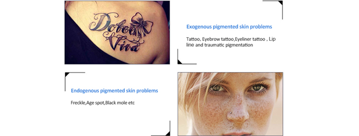 Todo lo que debe saber sobre la eliminación de tatuajes con láser