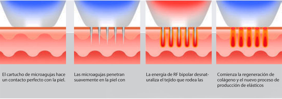 Sistema de RF fraccional de microagujas