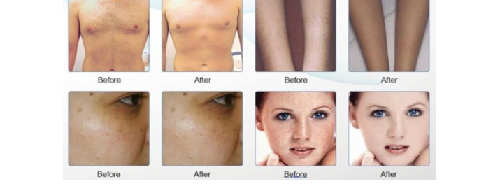 4 enfermedades de la piel que puedes tratar con una máquina de tratamiento láser