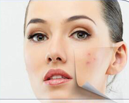 Recomendaciones para el tratamiento del acné