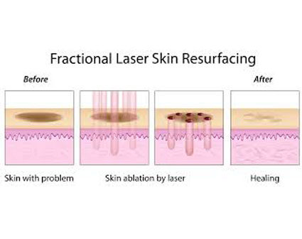 Tratamiento mínimamente invasivo de la cicatriz con láser fraccional